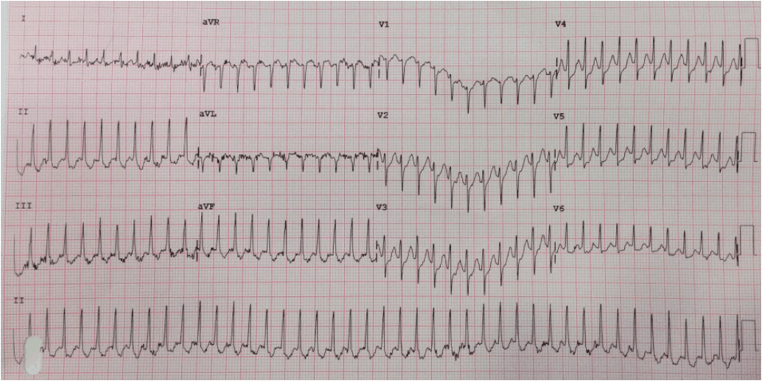 Dr. Smith's ECG Blog: A Very Fast Regular Narrow Complex, Followed by ...