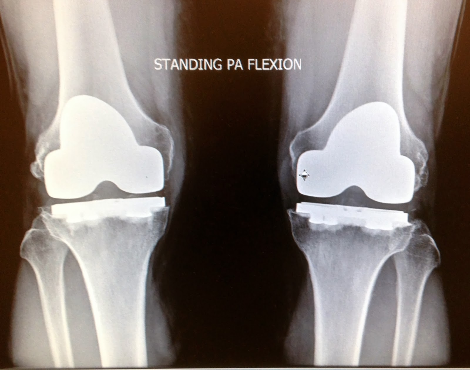 Patient's Progress Artificial Knees After Two Years, the Doctor Deems Knee Replacements as