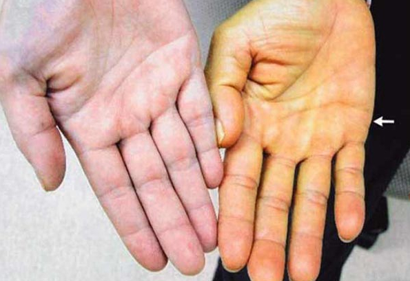 Liver Diseases Symptoms Liver Diseases Symptoms