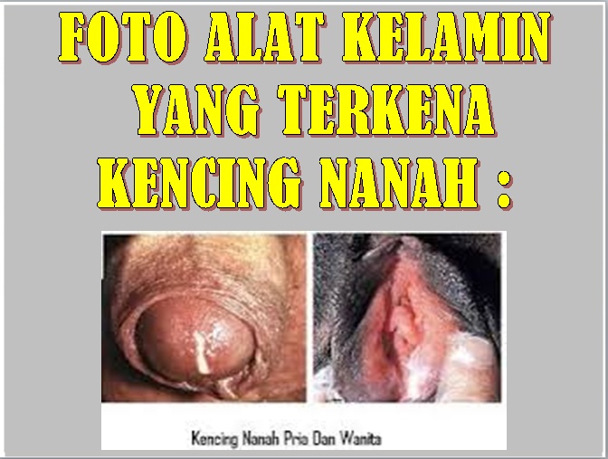 https://3.bp.blogspot.com/-CpJkATOsgZ4/WD15wWE3ogI/AAAAAAAAAdM/RcHtHxFo8fQTUOmABCDqyyOmLlvHZPZXACLcB/s1600/Kemaluan%2BMengeluarkan%2BNanah.png