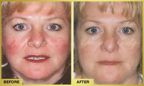 Perfect Body Laser And Aesthetics Rosacea Treatment