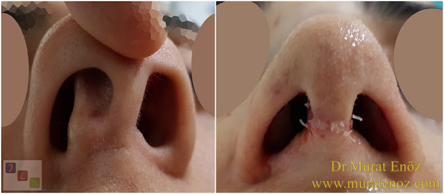 Twisted nose - Crooked nose surgery - Scoliotic nose - Crooked nose - Treatment of twisted nose  - Treatment of crooked nose - Challenges in treatment of deviated nose - Crooked nose aesthetic surgery in Istanbul - Twisted nose treatment in Istanbul - Rhinoplasty in Istanbul - Nose job in Istanbul
