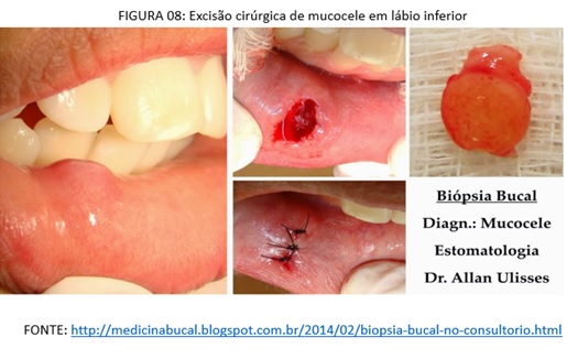Labial cie 10 mucocele
