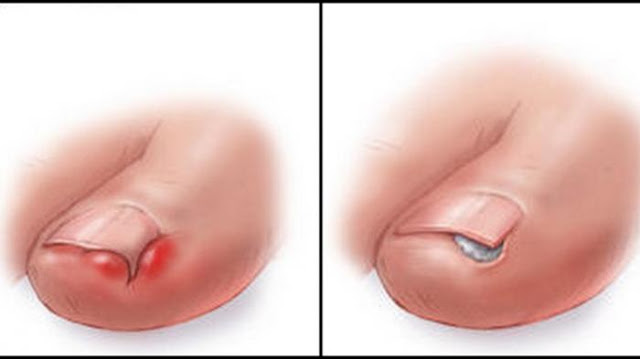 Cara Ini Sangat Mudah : Mengatasi Cantengan pada Kuku Kaki ! Cara Ini Sangat Mudah : Mengatasi Cantengan pada Kuku Kaki !