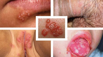 Obat Untuk Cacar Atau Herpes Pada Area Kemaluan