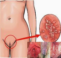 Penyebab Kutil Tumbuh Di Bibir Vagina