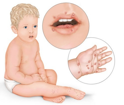 hand foot and mouth disease home remedies hand foot and mouth disease home remedies