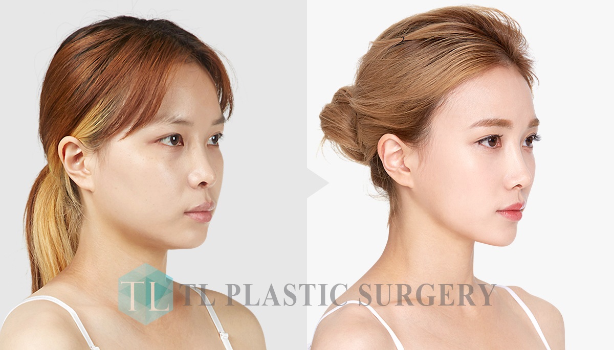 TL PLASTIC SURGERY CLINIC KOREA Before & After
