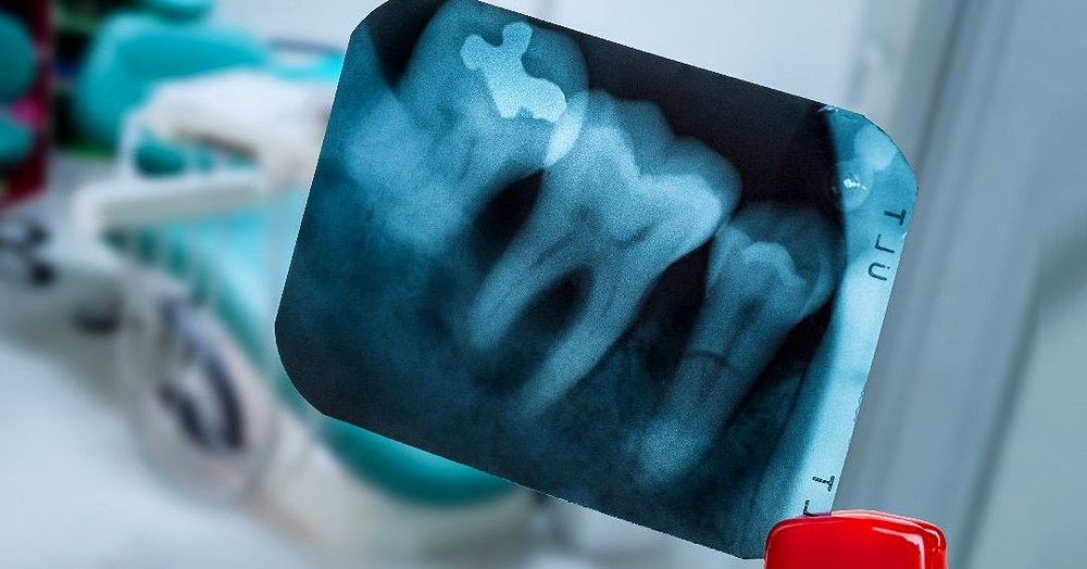 DENTAL RADIOLOGY How to Take Periapical Radiographs Directorio