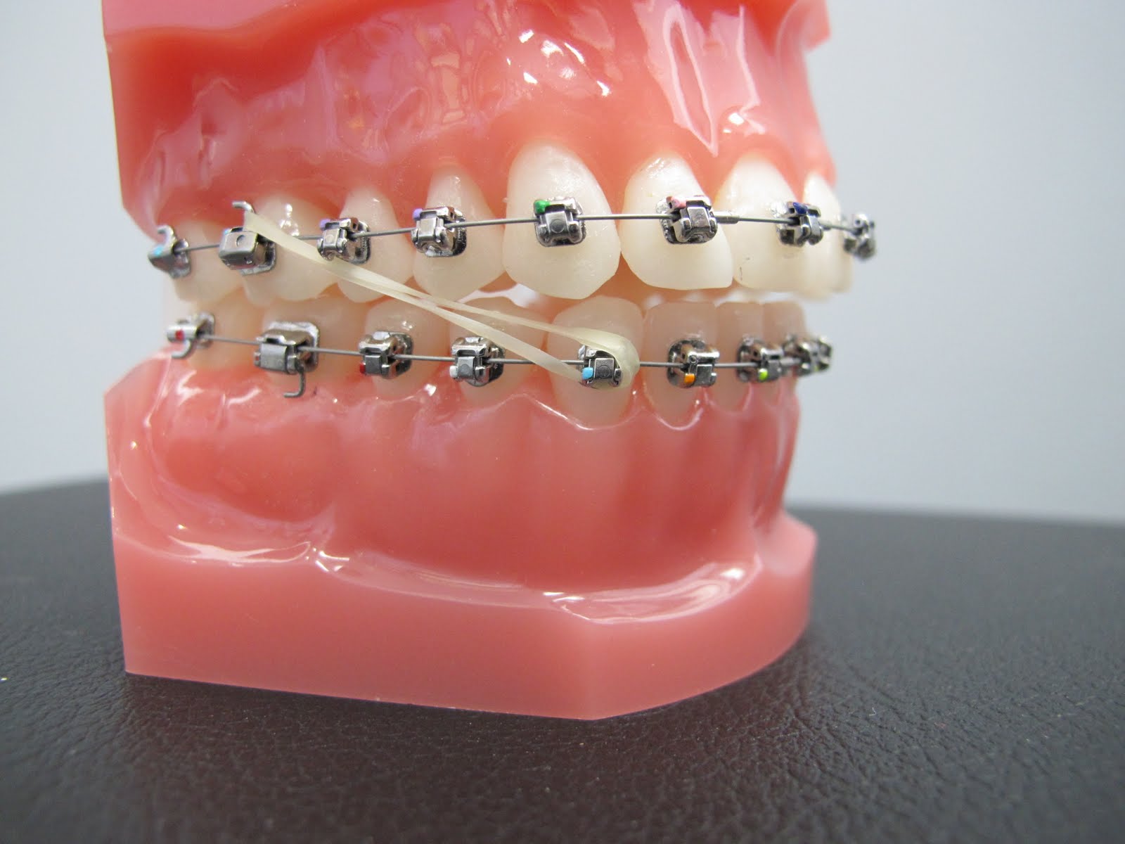 Boschken Orthodontics Why Does Dr. Boschken Wearing Your Elastics (Rubber Bands)?