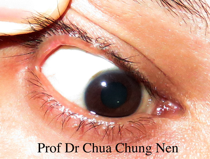 Eyelid Surgery by Prof Dr CN CHUA 蔡鐘能: Doctor, can you remove these ...