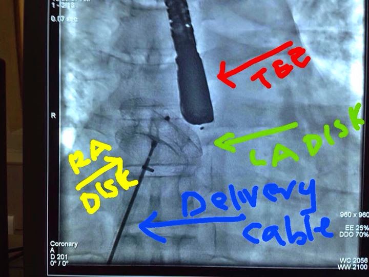 Atrial septal defect device closure