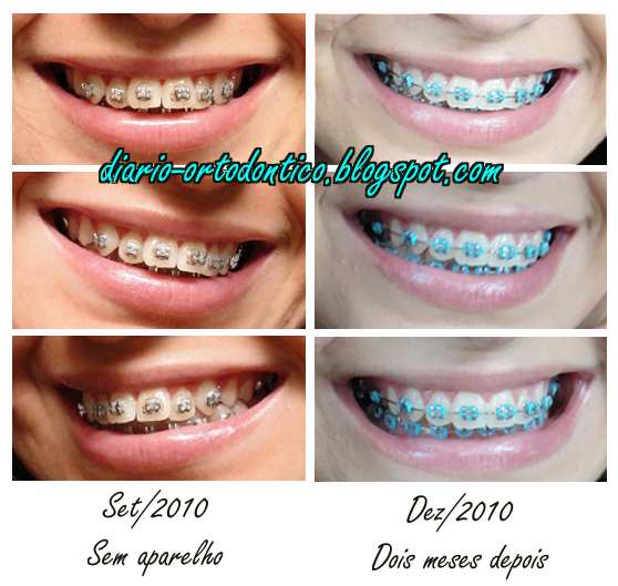 Aparelho Ortodontico Antes E Depois