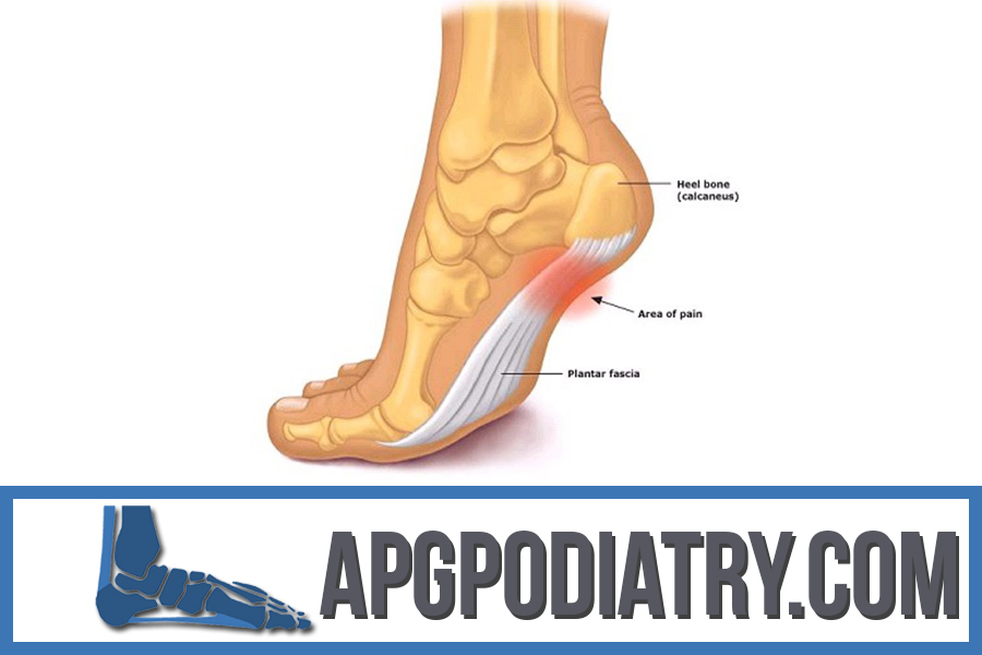APG Podiatry What Is Plantar Fasciitis?