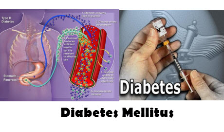 Diabetes mellitus диабет