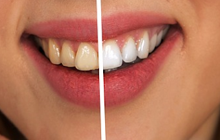 Should I Get Teeth Whitening?