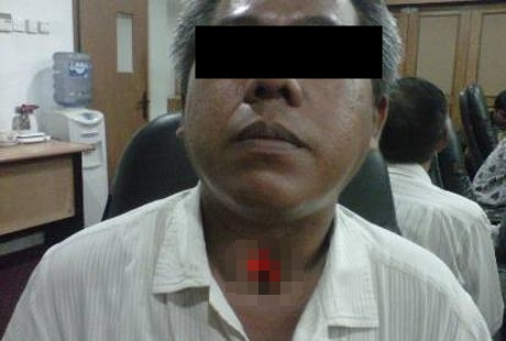 Akibat Makan Cabai Paling Pedas, Pria Ini Kerongkongannya Bolong