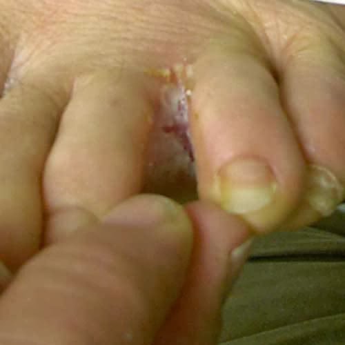 rash on arch of foot #10