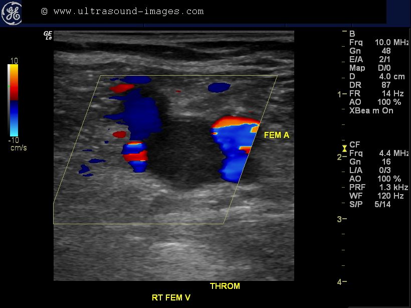 Deep vein thrombosis case study slideshare picture