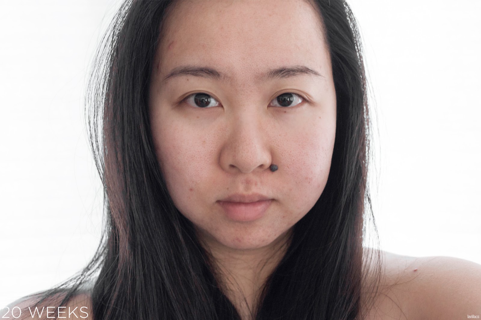 tria Hair Removal Laser Facial Hair 20 Weeks