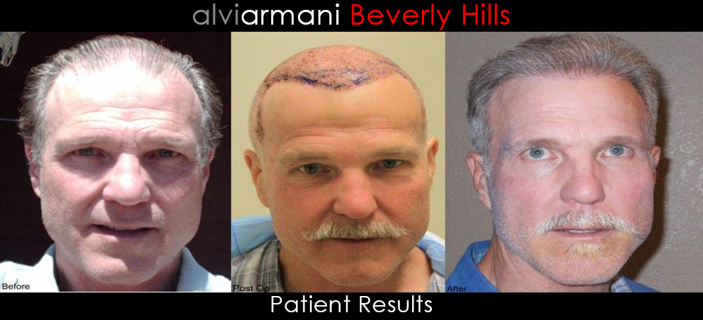 AlviArmani Patient Result #4