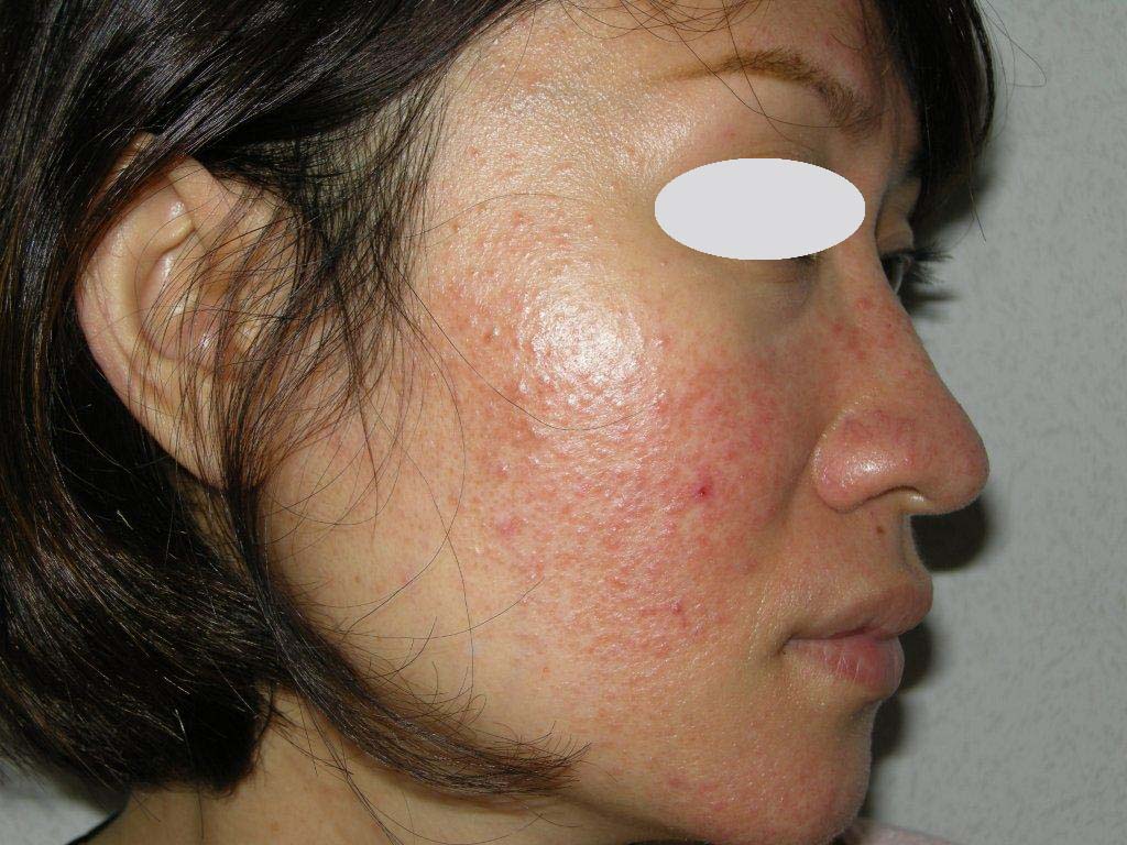 Steroid Induced Rosacea