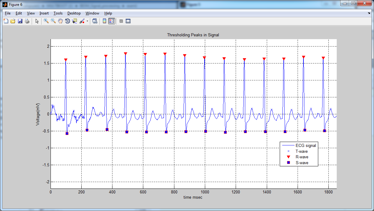 Biomedical Signal and Image Processing projects using Matlab and Labview tools Matlab code to