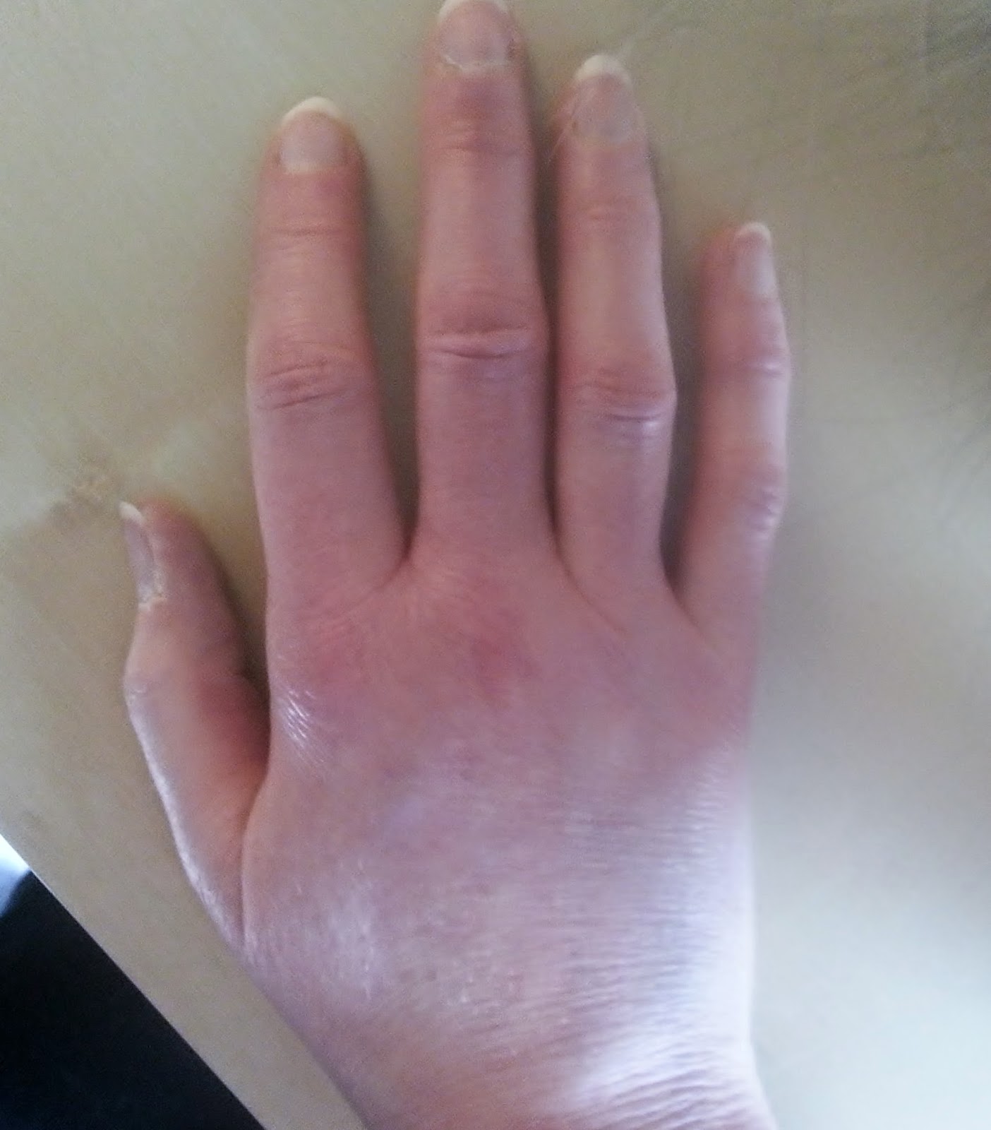 Puffiness Hand Auspicious Alltag: Rheumatoid arthritis update