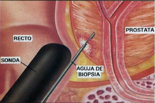 es una biopsia de la aguja prostática dolorosa