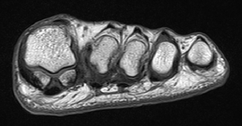 Foot and Ankle Problems By Dr. Richard Blake: Sesamoid ...