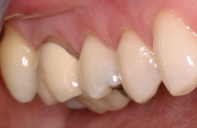 răng sứ kim loại thường
