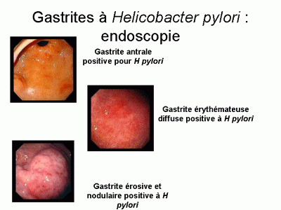 Gastrite Cronica Quiescente Non Atrofica Hp