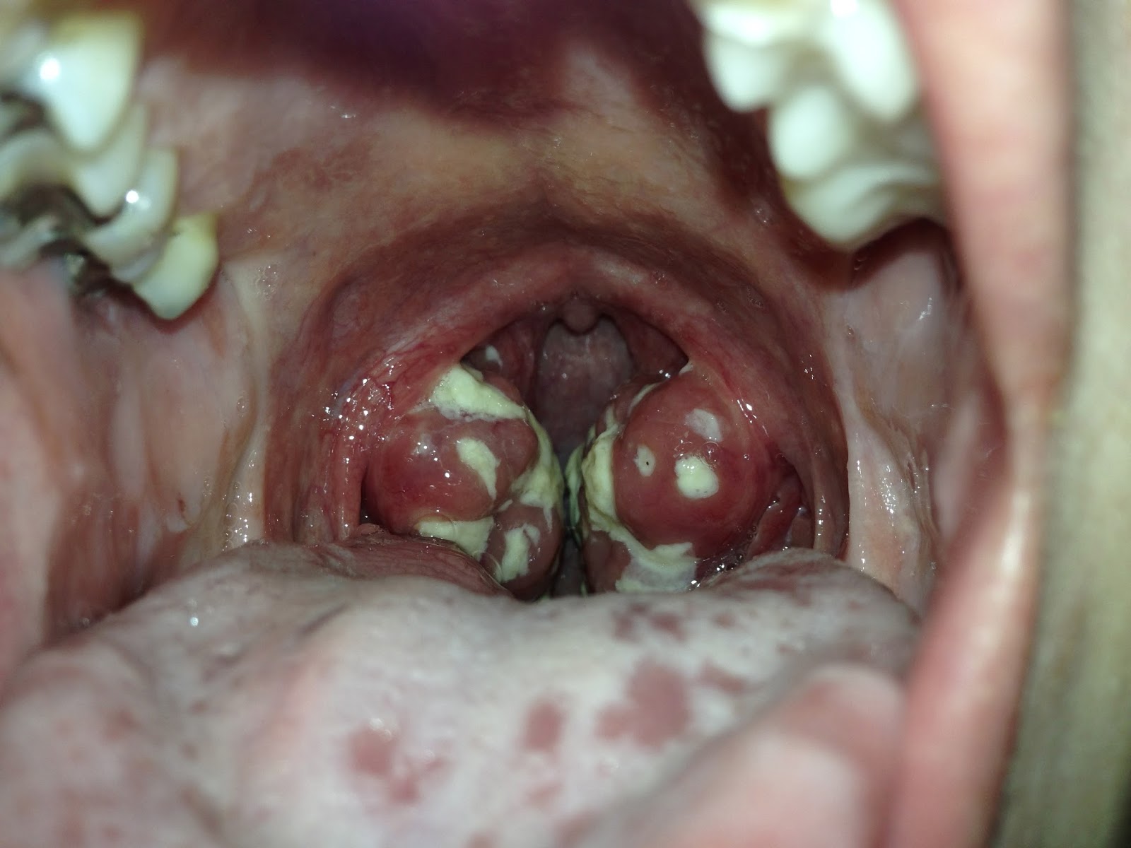 angina-ot-irrumatsii