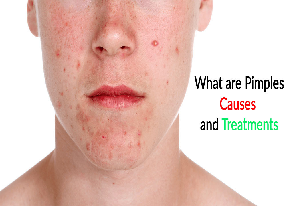 What are Pimples,Causes and Treatments - Care Online