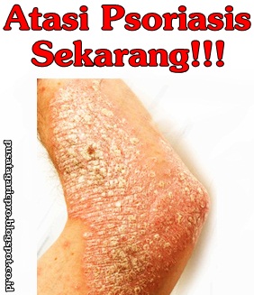Obat Psoriasis Obat Psoriasis
