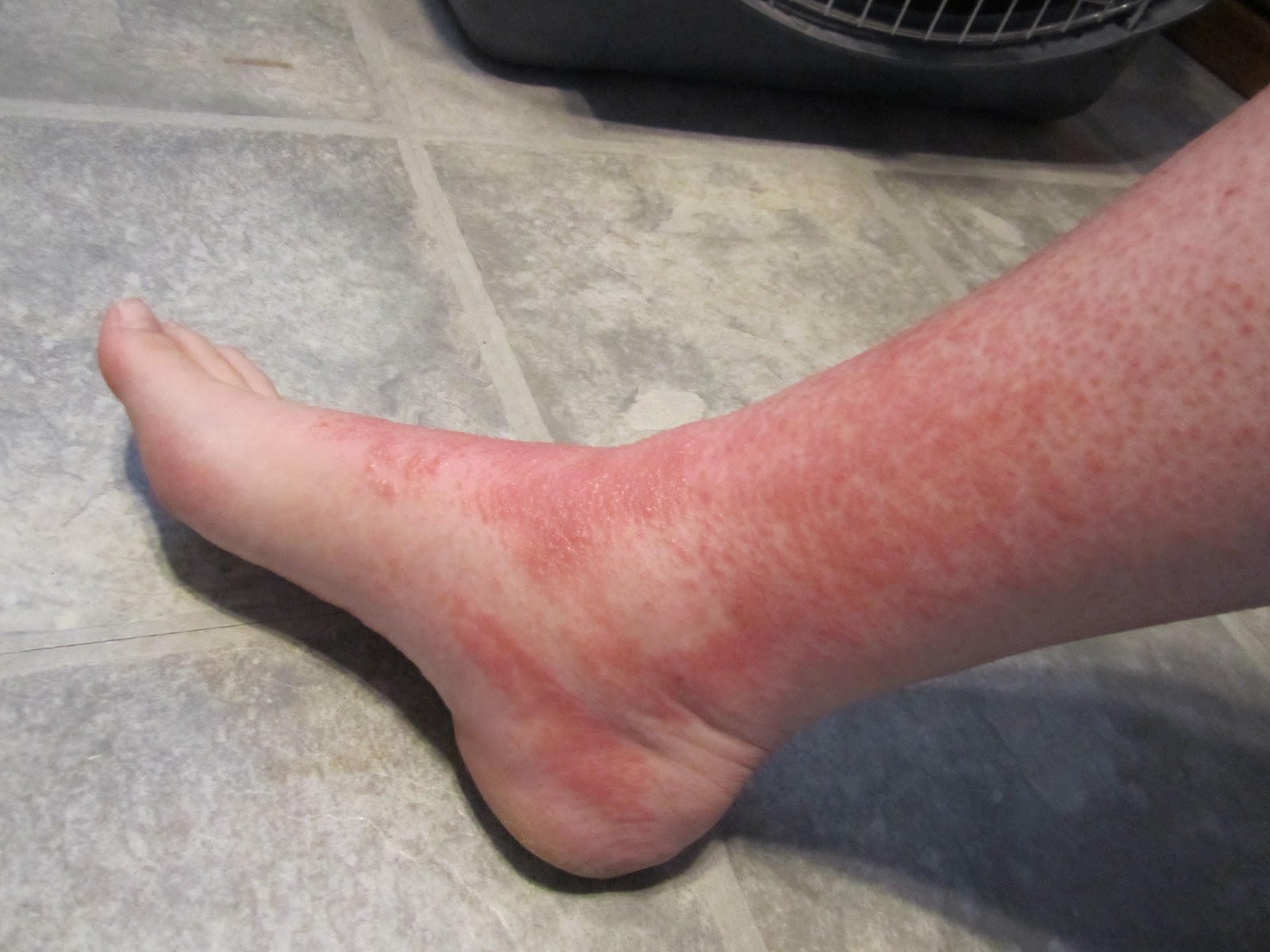 Large Red Blotches on Skin | LIVESTRONG.COM