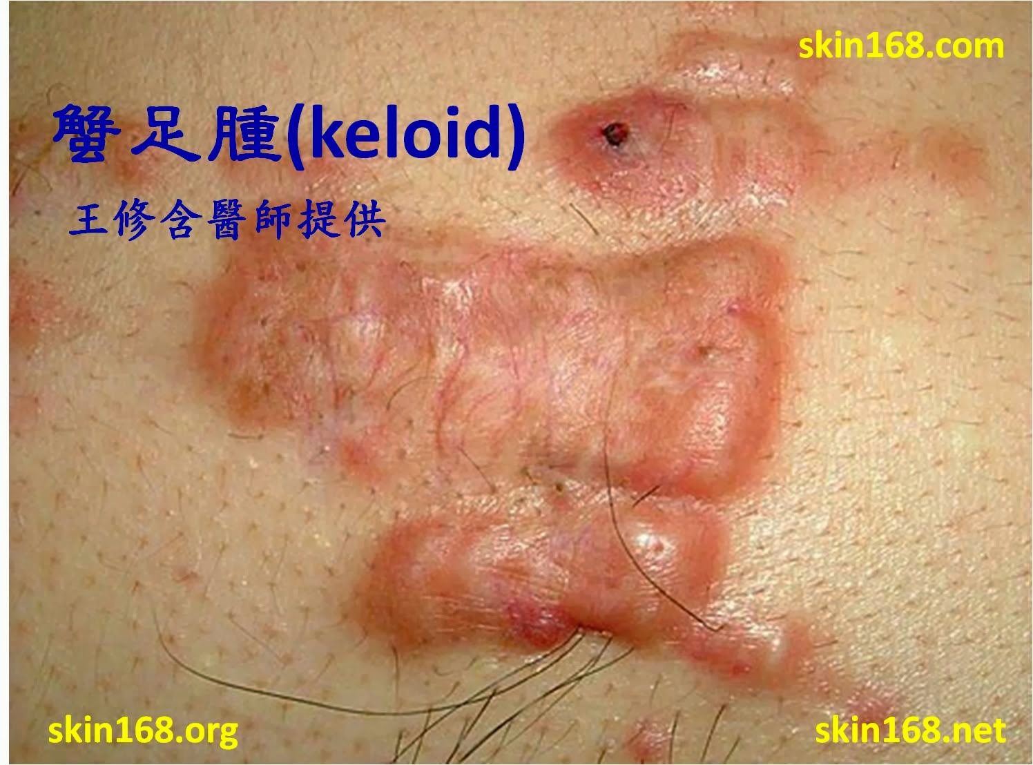 皮膚科王修含醫師 類固醇注射蟹足腫 肥厚性疤痕的副作用