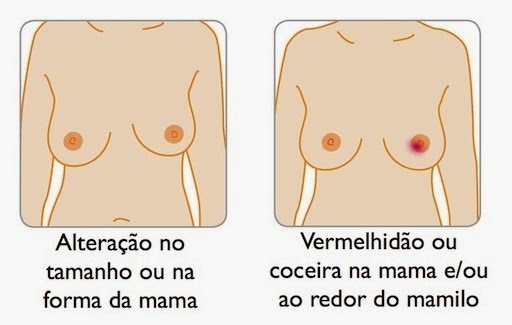 sintomas-cancer-mama-mulher-homem-prevencao-autoexame-mamografia-quimioterapia-dascoisasquetenhoaprendido