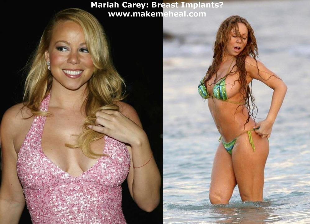 Mariah Carey Enlargement Breast Implants.