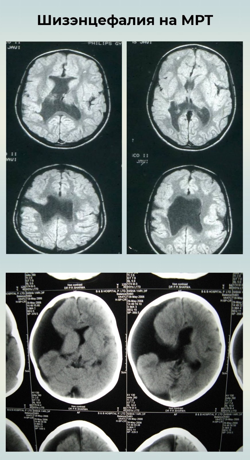 шизэнцефалия головного мозга у новорожденного на мрт