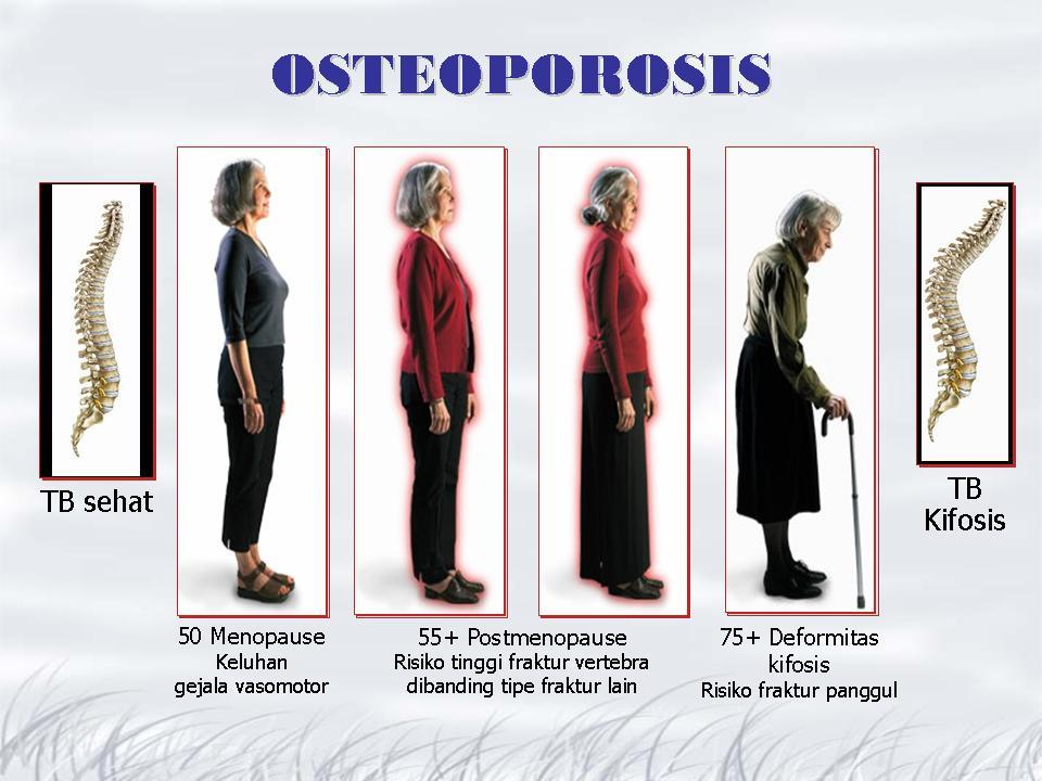 gambar penyakit tulang osteoporosis