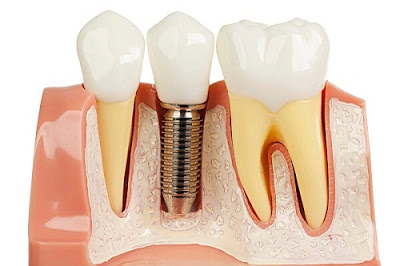 Cấy răng implant khi bị mất răng