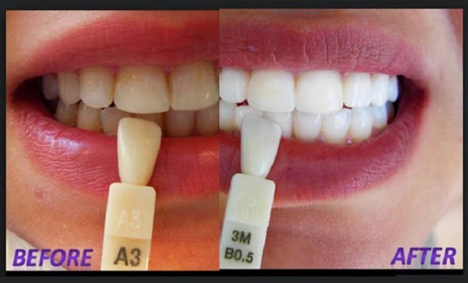 VIDEO How To Have Natural White Teeth in 3 minutes Works 100 GLOBAL