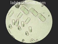 Urine Microscopic - Uric_acid_crystals