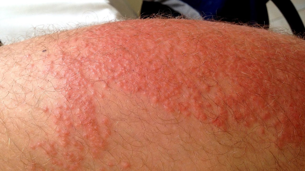 Itchy Skin Rash All Over Body Body Choices
