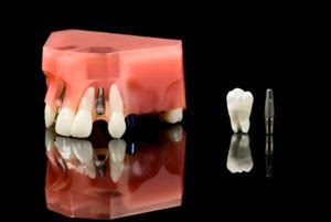 Greffe osseuse et implants dentaires