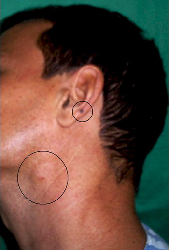 Acral-lentiginous melanoma | Primary Care Dermatology ...