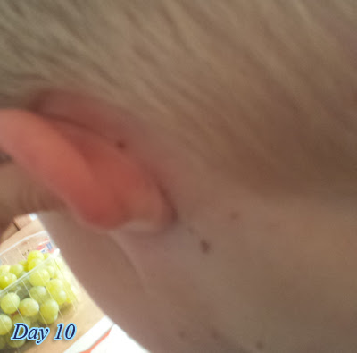 Day 10  Photos of Chicken Pox in their various stages