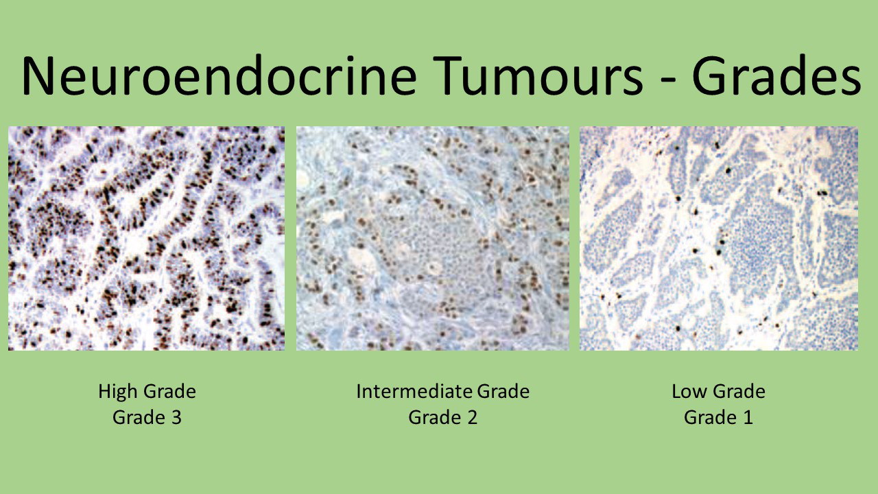 Endocrine tumors Grades