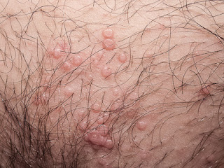 persona con moluscum contagioso